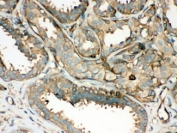 IHC testing of FFPE human breast cancer with ROCK2 antibody. HIER: Boil the paraffin sections in pH 6, 10mM citrate buffer for 20 minutes and allow to cool prior to staining.