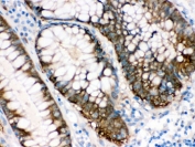 IHC testing of FFPE human intestinal cancer tissue with IDH1 antibody. HIER: Boil the paraffin sections in pH 6, 10mM citrate buffer for 20 minutes and allow to cool prior to staining.