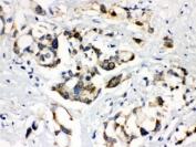 IHC testing of FFPE human liver cancer with ABCB11 antibody. HIER: Boil the paraffin sections in pH 6, 10mM citrate buffer for 20 minutes and allow to cool prior to staining.