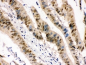 IHC testing of FFPE human intestinal cancer tissue with Pokemon antibody. HIER: Boil the paraffin sections in pH 6, 10mM citrate buffer for 20 minutes and allow to cool prior to staining.