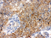 IHC testing of FFPE human lung cancer tissue with BAG3 antibody. HIER: Boil the paraffin sections in pH 6, 10mM citrate buffer for 20 minutes and allow to cool prior to staining.