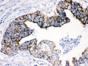 IHC testing of FFPE human intestinal cancer and AIF antibody. HIER: Boil the paraffin sections in pH 6, 10mM citrate buffer for 20 minutes and allow to cool prior to staining.