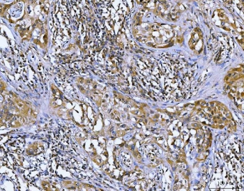 IHC staining of FFPE human lymph node carcinoma tissue with Bcl10 antibody. HIER: boil tissue sections in pH8 EDTA for 20 min and allow to cool before testing.~