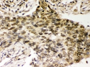 IHC testing of FFPE human lung cancer tissue with Chk2 antibody. HIER: Boil the paraffin sections in pH 6, 10mM citrate buffer for 20 minutes and allow to cool prior to staining.