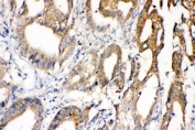 IHC staining of FFPE human intestinal cancer with SOD1 antibody. HIER: boil tissue sections in pH 8 EDTA for 20 min and allow to cool before testing.