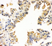 IHC staining of FFPE human lung cancer with SOD1 antibody. HIER: boil tissue sections in pH 8 EDTA for 20 min and allow to cool before testing.