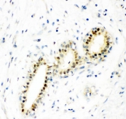 IHC staining of FFPE human breast cancer with SOD1 antibody. HIER: boil tissue sections in pH 8 EDTA for 20 min and allow to cool before testing.