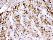 IHC testing of FFPE human liver cancer with Ceruloplasmin antibody. HIER: Boil the paraffin sections in pH 6, 10mM citrate buffer for 20 minutes and allow to cool prior to staining.