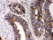 IHC testing of FFPE human intestinal cancer with HLA-A antibody. HIER: Boil the paraffin sections in pH 6, 10mM citrate buffer for 20 minutes and allow to cool prior to staining.