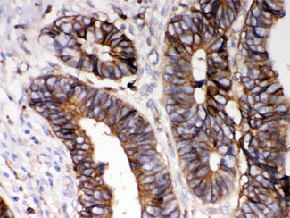 IHC testing of FFPE human intestinal cancer with HLA-A antibody. HIER: Boil the paraffin sections in p