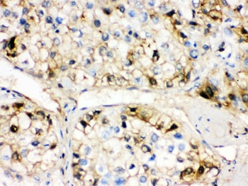 IHC testing of FFPE human liver cancer tissue with AHSG antibody. HIER: Boil the paraffin sections in pH 6, 10mM citrate buffer for 20 minutes and allow to cool prior to staining.