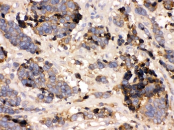IHC testing of FFPE human lung cancer tissue with Transthyretin antibody. HIER: Boil the paraffin sections in pH 8 EDTA buffer for 20 minutes and allow to cool prior to staining.~
