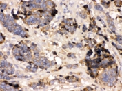IHC testing of FFPE human lung cancer tissue with Transthyretin antibody. HIER: Boil the paraffin sections in pH 8 EDTA buffer for 20 minutes and allow to cool prior to staining.
