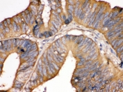 IHC testing of FFPE human intestinal cancer tissue with Transferrin antibody. HIER: Boil the paraffin sections in pH 6, 10mM citrate buffer for 20 minutes and allow to cool prior to staining.
