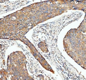 IHC staining of FFPE human esophageal cancer tissue with Transferrin antibody. HIER: boil tissue sections in pH8 EDTA for 20 min and allow to cool before testing.