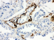 IHC testing of FFPE human lung cancer tissue with Vitronectin antibody. HIER: Boil the paraffin sections in pH 6, 10mM citrate buffer for 20 minutes and allow to cool prior to staining.