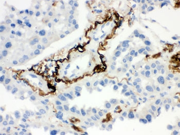 IHC testing of FFPE human lung cancer tissue with Vitronectin antibody. HIER: Boi