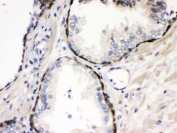 IHC testing of FFPE human prostate cancer with Cystatin B antibody. HIER: Boil the paraffin sections in pH 6, 10mM citrate buffer for 20 minutes and allow to cool prior to staining.