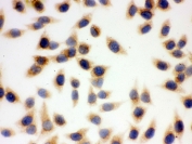 ICC testing of FFPE human SMMC-7721 cells with SOD2 antibody. HIER: steam section in pH6 citrate buffer for 20 min and allow to cool prior to testing.