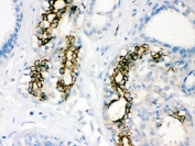 IHC testing of FFPE human breast cancer with SOD2 antibdoy. HIER: Boil the paraffin sections in pH 6, 10mM citrate buffer for 20 minutes and allow to cool prior to staining.