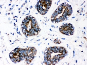 IHC testing of FFPE human breast cancer with CYP1A1 antibody. HIER: Boil the paraffin sections in pH 6, 10mM citrate buffer for 20 minutes and allow to cool prior to staining.
