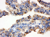 IHC testing of FFPE human kidney cancer tissue with ALDH2 antibody. HIER: Boil the paraffin sections in pH 6, 10mM citrate buffer for 20 minutes and allow to cool prior to staining.