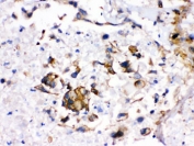 IHC testing of FFPE human liver cancer with CYP1A2 antibody. HIER: Boil the paraffin sections in pH 6, 10mM citrate buffer for 20 minutes and allow to cool prior to staining.