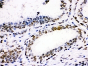 IHC testing of FFPE human breast cancer tissue with CDK1 antibody. HIER: Boil the paraffin sections in pH 6, 10mM citrate buffer for 20 minutes and allow to cool prior to staining.