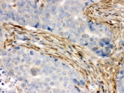 IHC testing of FFPE human breast cancer with S100A6 antibody. HIER: Boil the paraffin sections in pH 6, 10mM citrate buffer for 20 minutes and allow to cool prior to staining.