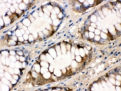 IHC testing of FFPE human intestinal cancer tissue with FABP antibody. HIER: Boil the paraffin sections in pH 6, 10mM citrate buffer for 20 minutes and allow to cool prior to staining.