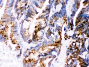 IHC testing of FFPE human intestinal cancer wtih Cathepsin D antibody. HIER: Boil the paraffin sections in pH 6, 10mM citrate buffer for 20 minutes and allow to cool prior to staining.