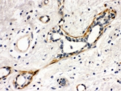IHC testing of FFPE human breast cancer tissue with Yes antibody. HIER: Boil the paraffin sections in pH 6, 10mM citrate buffer for 20 minutes and allow to cool prior to staining.