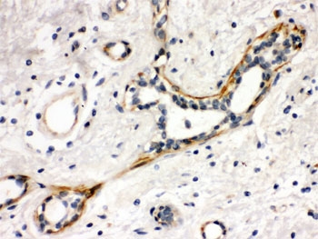 IHC testing of FFPE human breast cancer tissue with Yes antibody. HIER: Boil the paraffin sections in pH 6, 10mM citra