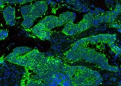 Immunofluorescent staining of human lung cancer with HSP90 beta antibody (green) at 2ug/ml and DAPI nuclear counterstain. HIER: Boil the paraffin sections in pH 6, 10mM citrate buffer for 20 minutes and allow to cool prior to staining.
