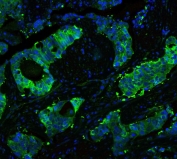 Immunofluorescent staining of human lung cancer with HSP90 beta antibody (green) at 2ug/ml and DAPI nuclear counterstain. HIER: Boil the paraffin sections in pH 6, 10mM citrate buffer for 20 minutes and allow to cool prior to staining.