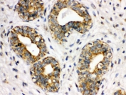 IHC testing of FFPE human breast cancer with CD41 antibody. HIER: Boil the paraffin sections in pH 6, 10mM citrate buffer for 20 minutes and allow to cool prior to staining.