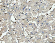IHC staining of FFPE human liver cancer tissue with CD14 antibody. HIER: boil tissue sections in pH8 EDTA for 20 min and allow to cool before testing.