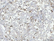 IHC staining of FFPE human lung cancer tissue with CD14 antibody. HIER: boil tissue sections in pH8 EDTA for 20 min and allow to cool before testing.