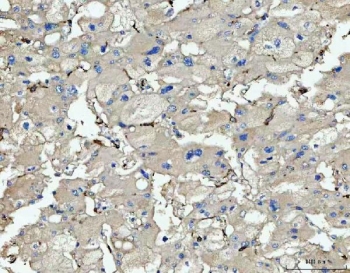 IHC staining of FFPE human liver cancer tissue with CD14 antibody. HIER: boil tissue sections in pH8 EDTA for 20 min and allow to cool before testing.