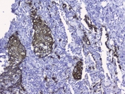 IHC testing of FFPE human lung cancer tissue with CK19 antibody. HIER: Boil the paraffin sections in pH 6, 10mM citrate buffer for 20 minutes and allow to cool prior to staining.