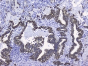 IHC testing of FFPE human lung cancer tissue with CK19 antibody. HIER: Boil the paraffin sections in pH 6, 10mM citrate buffer for 20 minutes and allow to cool prior to staining.