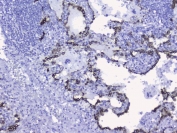 IHC testing of FFPE human lung cancer tissue with CK19 antibody. HIER: Boil the paraffin sections in pH 6, 10mM citrate buffer for 20 minutes and allow to cool prior to staining.