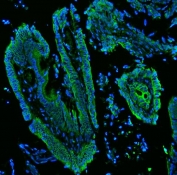 Immunofluorescent staining of FFPE human colon cancer with CK19 antibody (green) and DAPI nuclear stain (blue). HIER: steam section in pH8 EDTA buffer for 20 min.