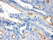 IHC testing of FFPE human intestinal cancer with Villin antibody. HIER: Boil the paraffin sections in pH 6, 10mM citrate buffer for 20 minutes and allow to cool prior to staining.