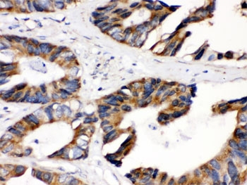 IHC testing of FFPE human intestinal cancer with DLD antibody. HIER: Boil the paraffin sections in pH 6, 10mM citrate buffer for 20 minutes and allow to cool prior to staining.