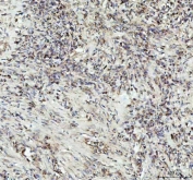 IHC staining of FFPE human lung squamous cell carcinoma tissue with G-CSF antibody. HIER: boil tissue sections in pH8 EDTA for 20 min and allow to cool before testing.