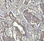 IHC staining of FFPE human rectum adenocarcinoma tissue with G-CSF antibody. HIER: boil tissue sections in pH8 EDTA for 20 min and allow to cool before testing.