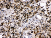 IHC testing of FFPE human glioma tissue with PGP 9.5 antibody. HIER: Boil the paraffin sections in pH 6, 10mM citrate buffer for 20 minutes and allow to cool prior to staining.