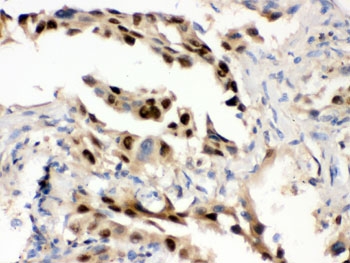 IHC testing of FFPE human lung cancer tissue with HSP70 antibody. HIER: Boil the paraffin sections in pH 6, 10mM citrate buffer for 20 minutes and allow to cool prior to staining.