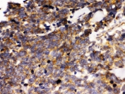 IHC testing of FFPE human lung cancer tissue with PTPRF antibody. HIER: Boil the paraffin sections in pH 6, 10mM citrate buffer for 20 minutes and allow to cool prior to staining.